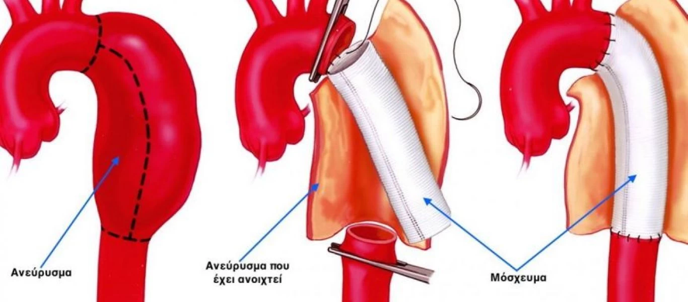 Ανεύρυσμα αορτής: Πότε θα πρέπει να κάνετε τσεκάπ